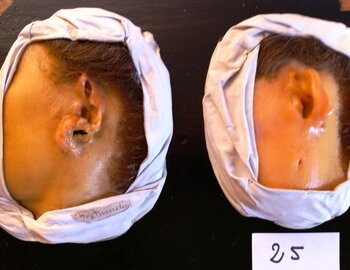 1907	cancer cutané oreille gauche