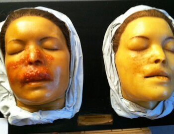 1904	lupus face avant et après traitement